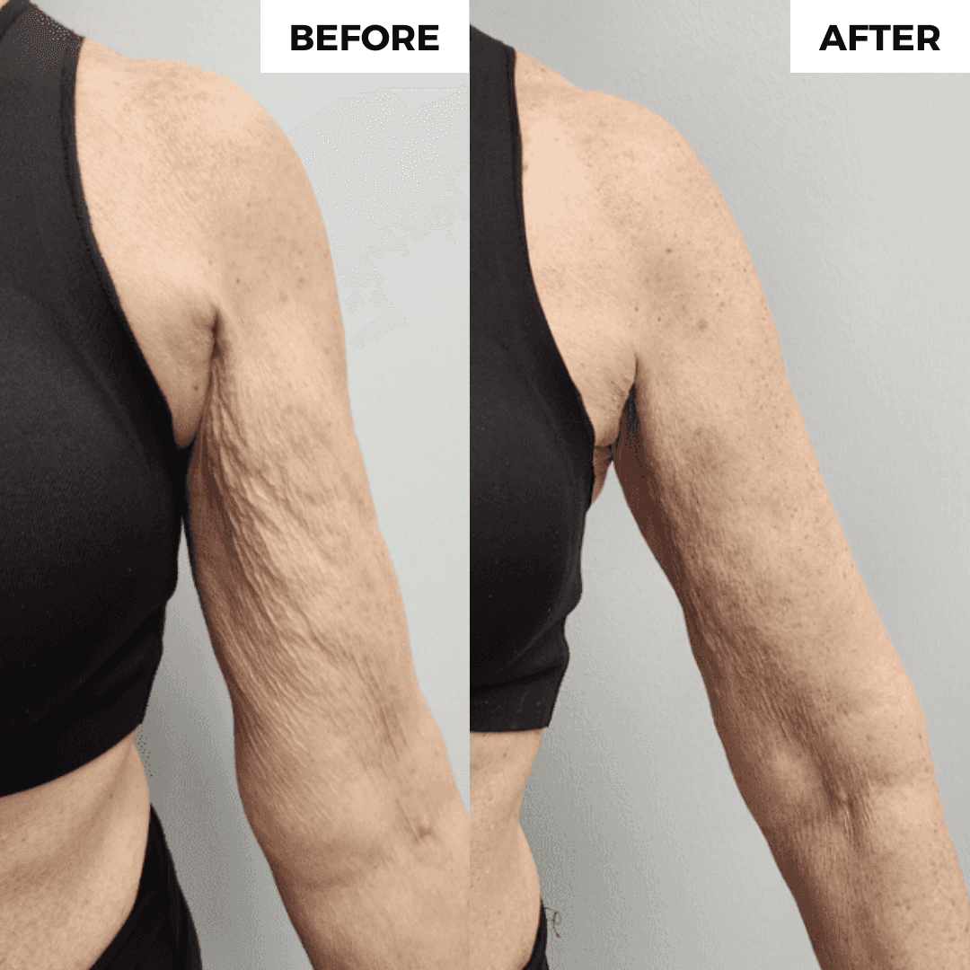 Before and after comparison showing firmer arm skin after using Confitone