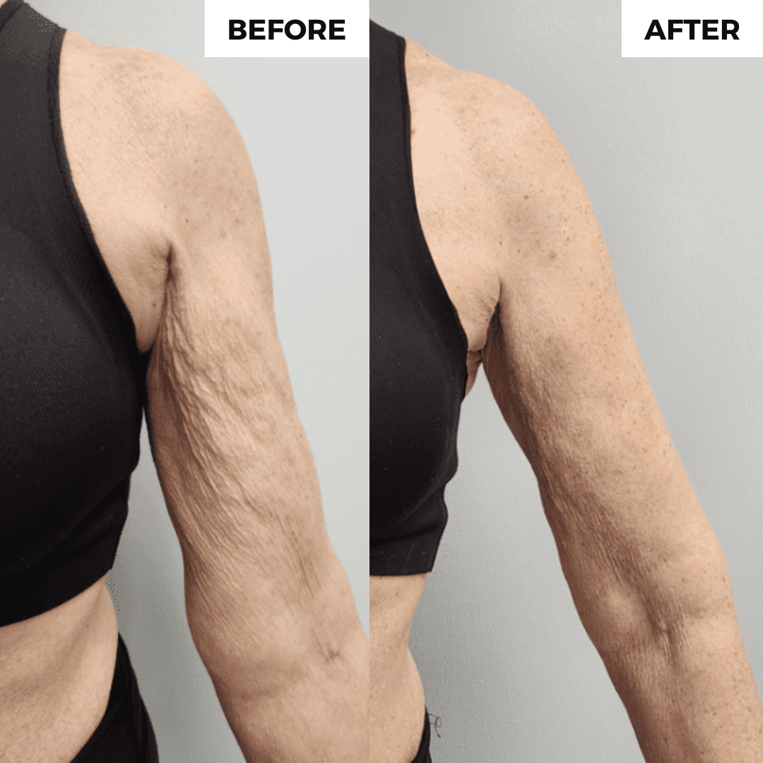 Confitone® ThermoTone Arm Sleeve